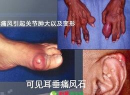 尿酸高痛風吃什么藥,痛風吃什么藥好得快