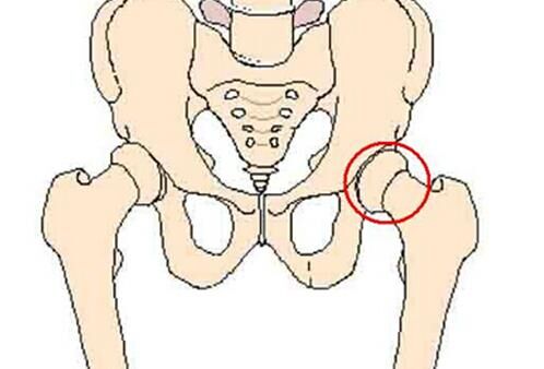 股骨頭壞死治療期間服用注意事項，通絡生骨膠囊禁忌