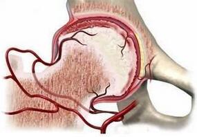 股骨頭壞死的治療，什么是股骨頭壞死