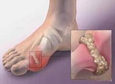 痛風(fēng)吃什么藥效果最好,痛風(fēng)吃什么藥好得快