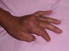 痛風吃什么藥效果最好,痛風吃什么藥好得快