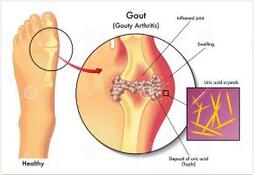 痛風(fēng)吃什么藥，痛風(fēng)吃什么藥效果最好