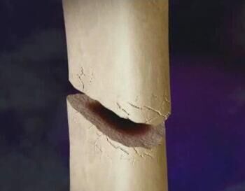 什么是股骨頭壞死，股骨頭壞死吃什么藥好