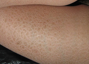 魚鱗病治療吃什么藥好，魚鱗皮膚病的治療方法