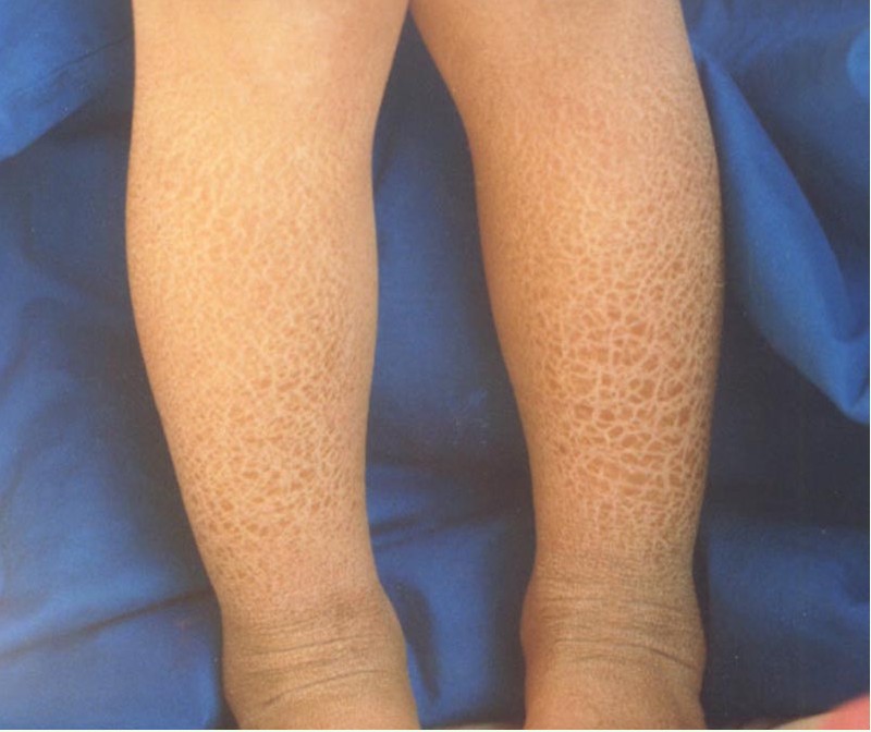 魚鱗皮膚病的治療方法，參歸潤燥搽劑怎么樣