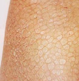 遺傳性魚鱗病吃什么藥，參歸潤燥搽劑怎么樣