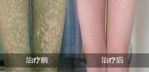 遺傳性魚鱗病吃什么藥，參歸潤燥搽劑效果怎么樣