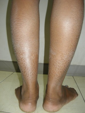 魚鱗病吃什么藥，參歸潤燥搽劑好嗎