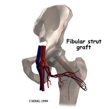 拯救股骨頭患者，通絡生骨膠囊治療股骨頭壞死的療效