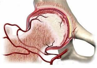 股骨頭壞死的治療，股骨頭壞死的各分期該怎么治療