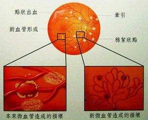 糖尿病視網膜病變的護理，芪明顆粒有副作用嗎