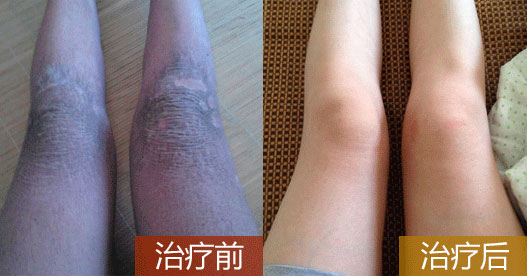 治魚鱗病吃什么藥，魚鱗皮膚病如何治療