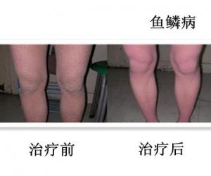 魚鱗皮膚病的治療方法，參歸潤燥搽劑效果怎么樣