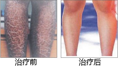 魚鱗皮膚病的治療方法，參歸潤燥搽劑效果怎么樣