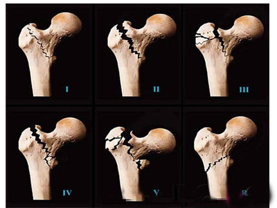 股骨頭壞死有哪幾個(gè)分期，股骨頭壞死每個(gè)分期怎么治療