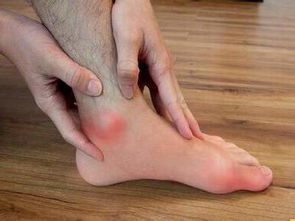 風定寧片價格，非布司他片價格