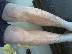 魚鱗皮膚病的治療方法，參歸潤燥搽劑怎么樣