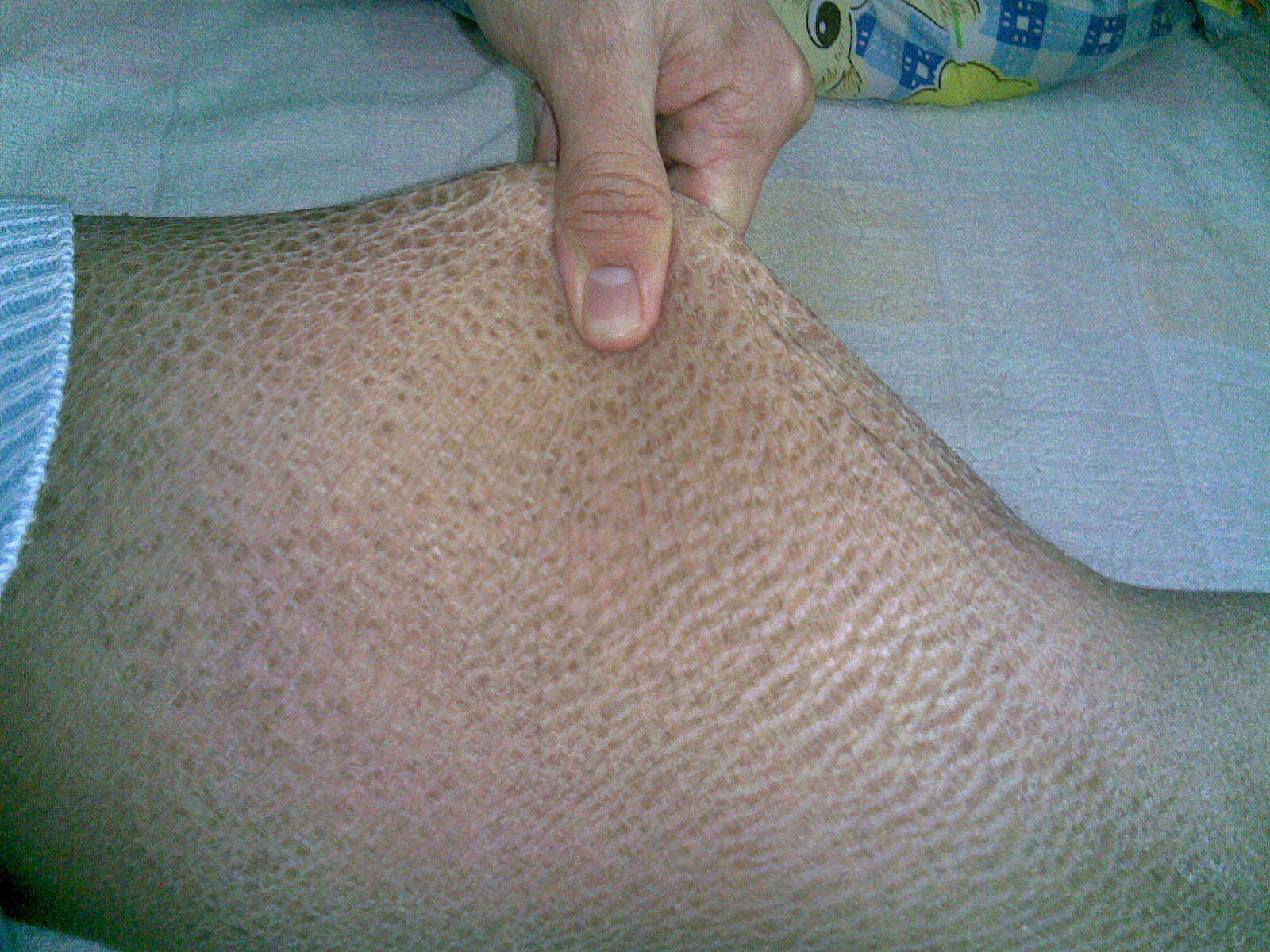 魚鱗皮膚病的治療方法，參歸潤燥搽劑效果怎么樣