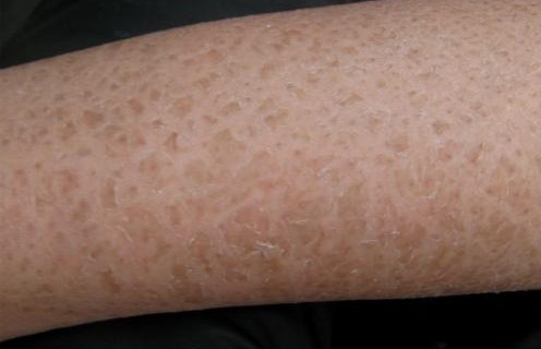 魚鱗皮膚病如何治療，參歸潤燥擦劑