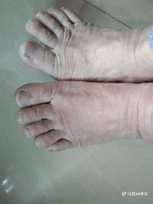 非布司他片說明書，優立通怎么用