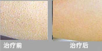 參歸潤燥擦劑，魚鱗皮膚病如何治療