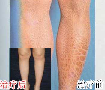 先天性魚鱗癬，參歸潤燥搽劑怎么樣