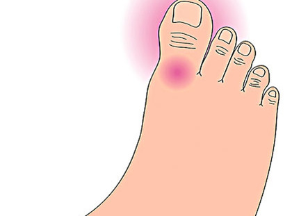 痛風(fēng)用什么藥治療，非布司他片