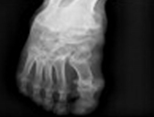 尿酸高痛風吃什么藥,痛風吃什么藥好得快