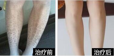 治療魚鱗病吃什么藥好，吃什么藥能治魚鱗病