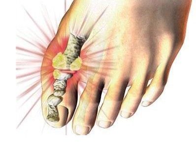 風定寧價格，非布司他片哪里能買到正品