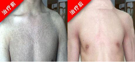 魚鱗皮膚病的治療方法，參歸潤燥擦劑