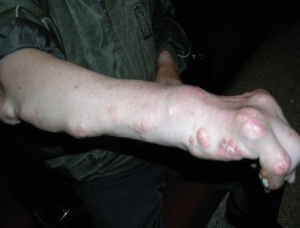 股骨頭壞死的治療，股骨頭壞死吃什么藥好