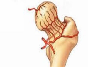 什么是股骨頭壞死，股骨頭壞死有哪幾個分期