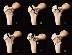 通絡(luò)生骨膠囊價格，通絡(luò)生骨膠囊在哪里購買