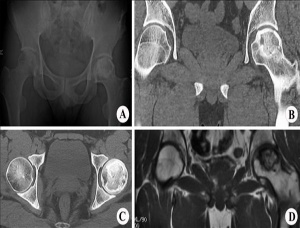 什么是股骨頭壞死，股骨頭壞死有哪幾個分期