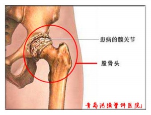 股骨頭壞死怎么治療，通絡生骨膠囊怎么服用