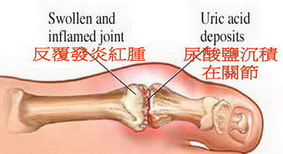 痛風(fēng)吃什么藥好得快,優(yōu)立通 非布司他片