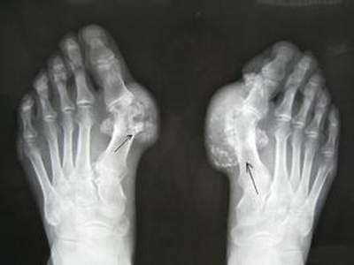 優(yōu)立通一次用多少為好，優(yōu)立通怎么用