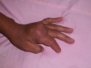 風定寧用法，風定寧非布司他片