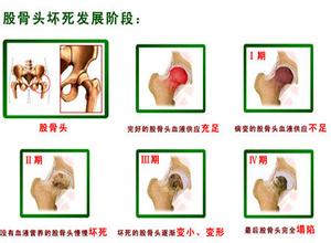 股骨頭壞死的治療，什么是股骨頭壞死