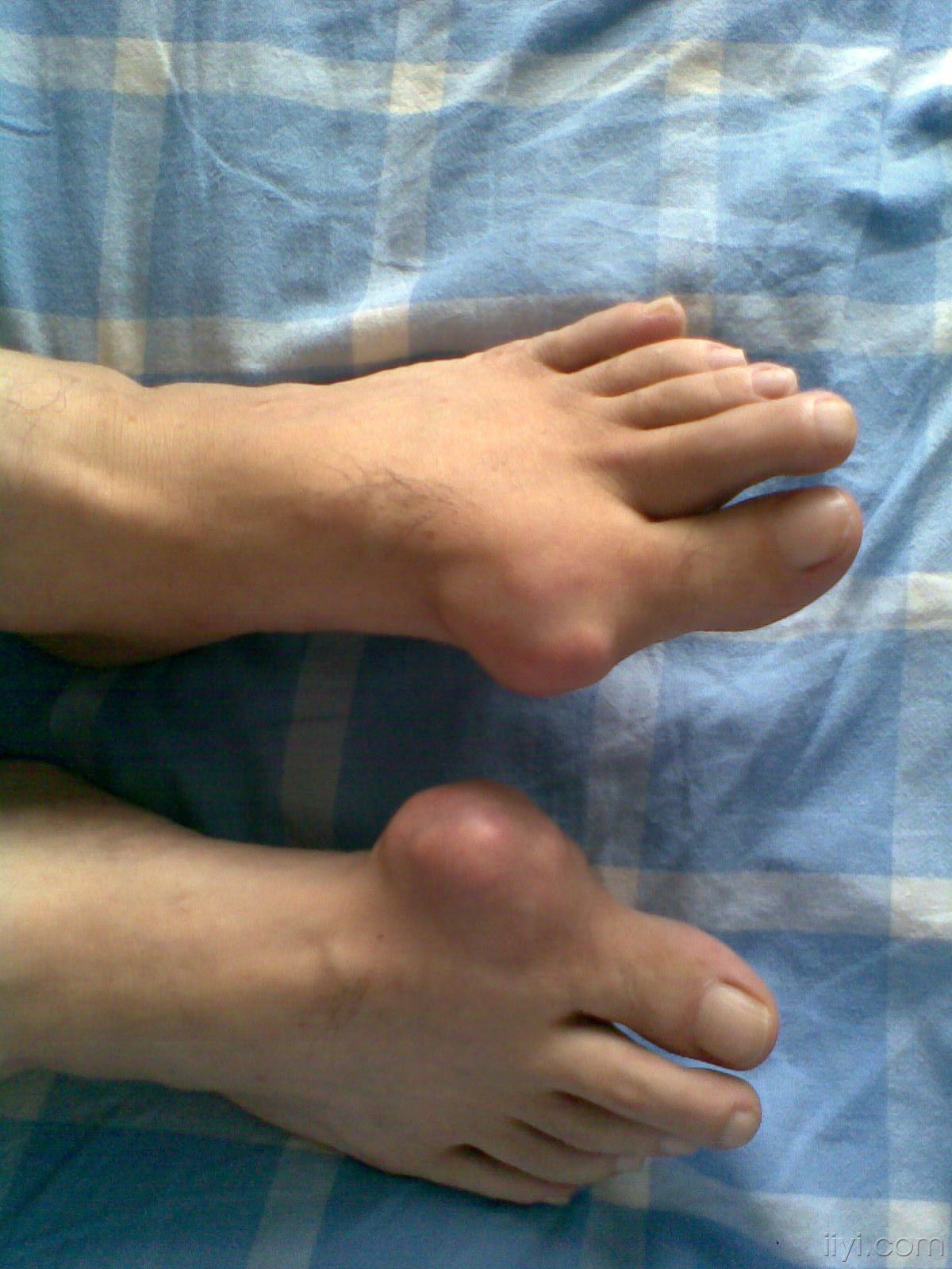 痛風吃什么藥,痛風吃什么藥效果最好