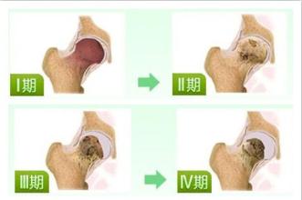 股骨頭壞死的治療,股骨頭壞死吃什么藥好