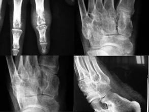 優立通藥店售價,優立通一個療程多少錢