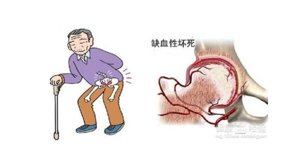股骨頭壞死治療期間服用注意事項,通絡生骨膠囊不良反應