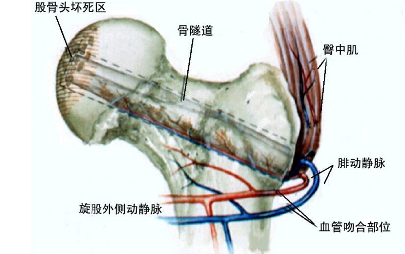 中期怎么使用通絡生骨膠囊,晚期怎么使用通絡生骨膠囊