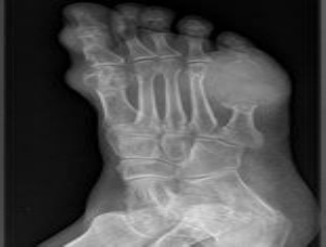 痛風吃什么藥效果最好,痛風吃什么藥好得快