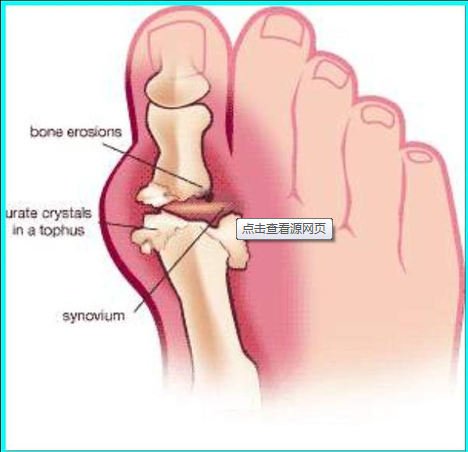 痛風吃什么藥效果最好,風定寧片