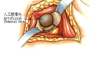 什么是股骨頭壞死,股骨頭壞死吃什么藥好