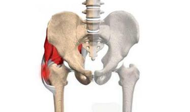 股骨頭壞死怎么治療,通絡生骨膠囊怎么服用