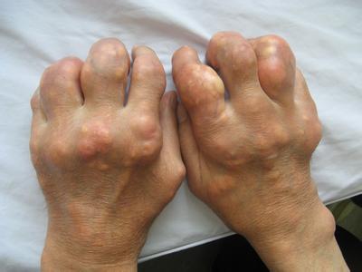 痛風病食物，痛風吃什么菜